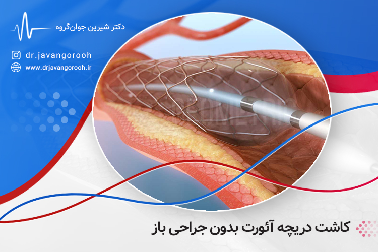 کاشت دریچه آئورت بدون جراحی باز
